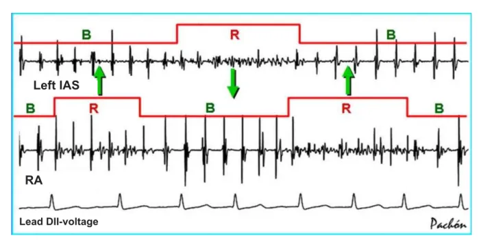 Fig. 5 - Simultaneous tracings showing the dynamic behavior of the AF nests. During the AF, a periodical electrical instability occurs, which promotes the alternateness  of high and low frequencies – the resonant and bystander states