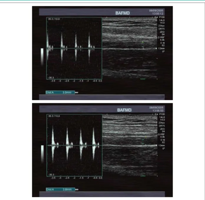 Fig. 1 - Typical example of baseline (above) and post reactive hyperemia (below) brachial artery ultrasound images.