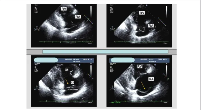 Fig. 1 - Two-dimensional transthoracic echocardiogram. Parasternal view of right chambers