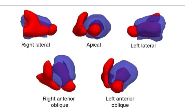 Fig. 2 - The fusion of myocardial perfusion (in semitransparent blue) and blood pool (solid red) images is represented in three-dimensional volumes with view angles