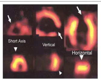Fig. 1 - The perfusion study with 99 mTc SESTAMIBI (short axis, horizontal  and vertical) performed in the prior assessment of the patient to evaluate  the indication of mononuclear cell transplantation is presented in the upper  part of the figure and sho