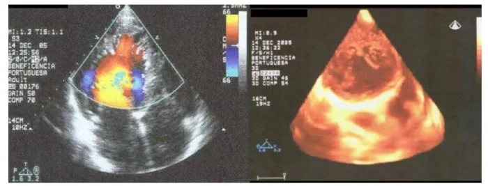 Fig. 1 - On the left, transthoracic two-dimensional echocardiography (in apical four chamber view), demonstrating sinusoids shown by color flow mapping