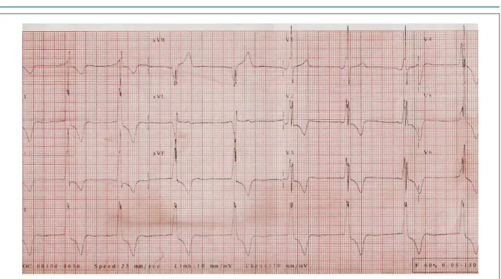 Fig. 2 - ECG. Presence of preexcitation (delta wave), left ventricular overload and changes in strain ventricular repolarization, similar to the previous one (Fig 1).