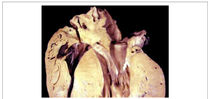 Fig. 3 - Longitudinal section of the basal region of the heart showing a marked degree of ventricular myocardial hypertrophy.