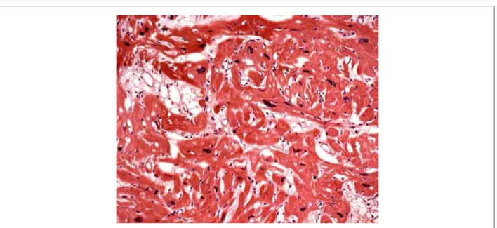 Fig. 5 - Histological section of the myocardium showing hypertrophy and cardiomyocyte disarray