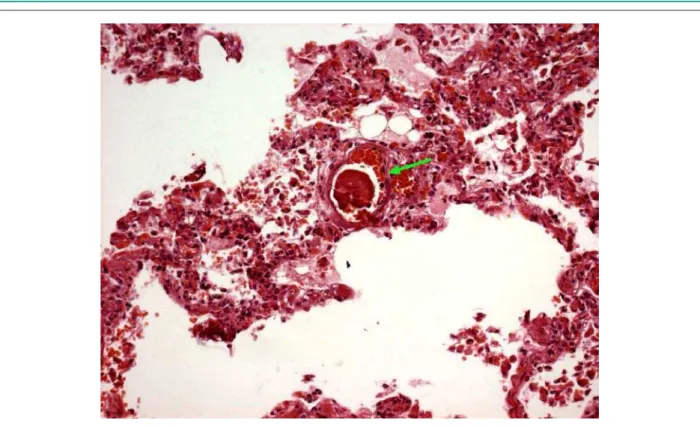 Fig. 7 - Histological section of the lung, showing a focus of recent thrombosis occluding a small-diameter vessel