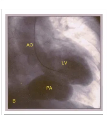 Fig. 1-B - Left cineangioventriculography (LV) showing large pseudoaneurysm  (PA) of left ventricular inferior wall