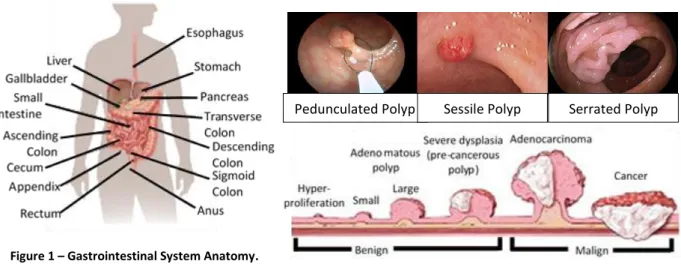 Figure 2 – Different types of polyps and how they turn into cancer.