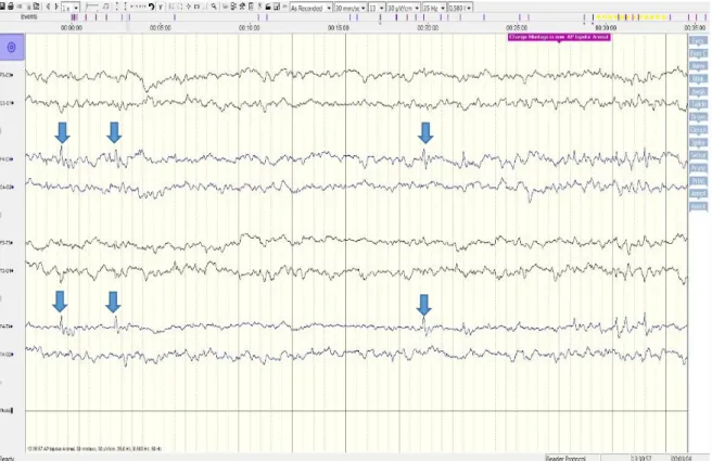 Figura 4 – Traçado do EEG realizado. Alterações ( Pontas isoladas) indicadas pelas setas azuis