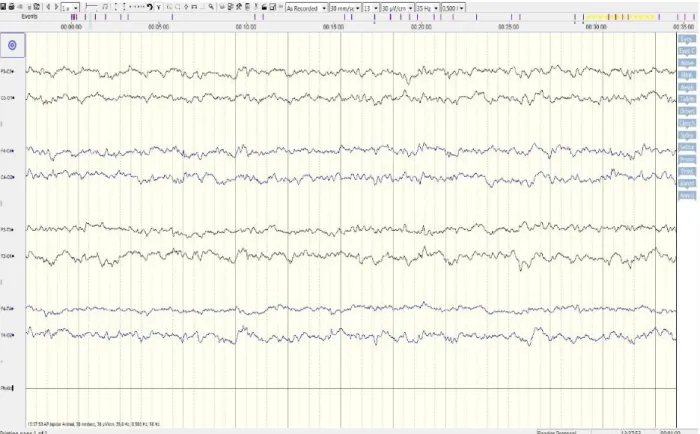 Figura 6 – Traçado do EEG realizado sem alterações detetáveis.