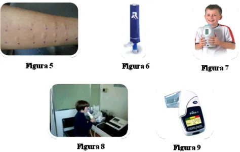 Figura 5: Fotografia de braço de criança após testes cutâneos por picada. 