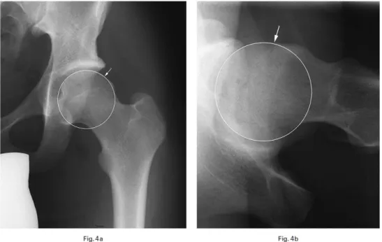 Figura 4  [5]  - Radiografias da anca mostrando um conflito do tipo &#34;cam&#34;. Incidência AP  (4a) e &#34;cross-table&#34; (4b) mostrando uma asfericidade da cabeça do fémur