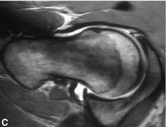 Figura 15  [13]  - RMN mostrando lesão labral e condral  num doente com conflito do tipo &#34;cam&#34;