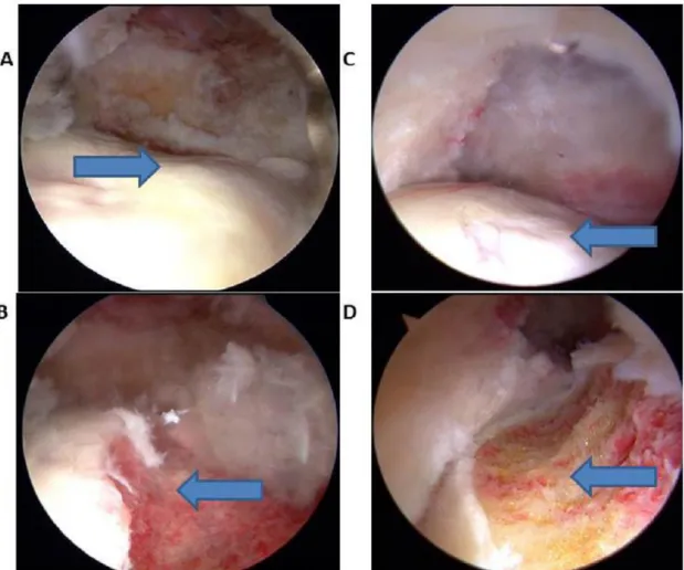 Figura 17  [34]  - Fotografias obtidas durante a artroscopia de um doente com conflito do tipo &#34;cam&#34;, com  imagens pré (A;C) e pós-operatória (B;D) de 2 doentes