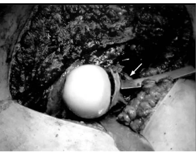 Figura 18  [26]  - Imagem obtida após luxação cirúrgica da anca, na qual se verifica proteção dos vasos da  cabeça do fémur (seta)
