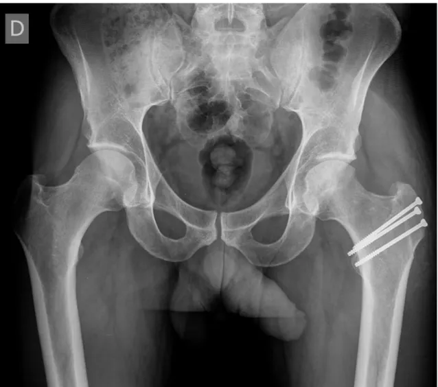 Figura 19 – Radiografia AP pós-operatória, de doente submetido a tratamento cirúrgico por via aberta a  conflito do tipo “cam”