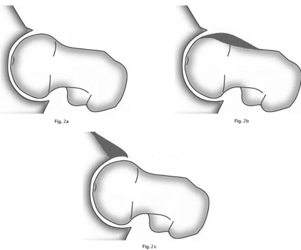 Figura 2  [10]  - Diagrama ilustrando: a) anca com morfologia normal; b) “impingement” do tipo “cam” 