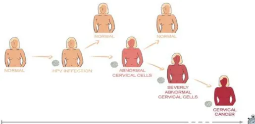 Ilustração 1.3.1. - Evolução da infeção por HPV (http://www.ecca.info/pt/cervical-cancer/cancro- (http://www.ecca.info/pt/cervical-cancer/cancro-do-colo-do-utero.html) 
