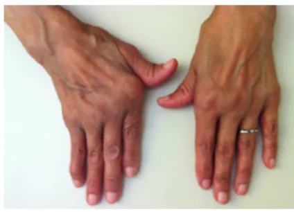 Figure 16: Jaccoud's Hand Pathology  Figure 17: Clubfoot Pathology 