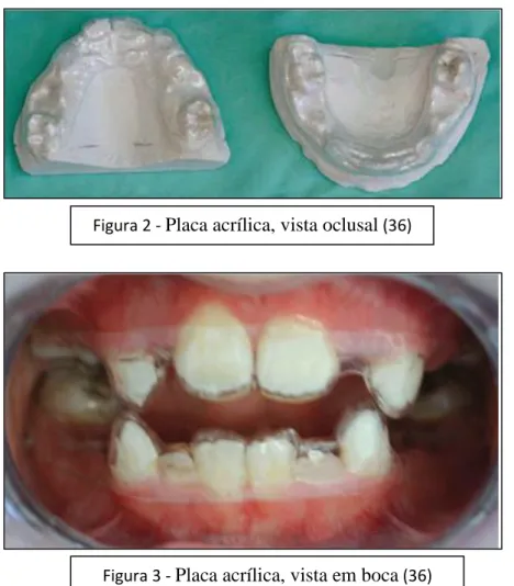 Figura 3 -  Placa acrílica, vista em boca  (36) Figura 2 - Placa acrílica, vista oclusal (36) 