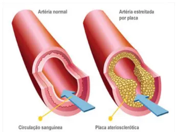 Figura 11 – Comparação entre uma artéria saudável e uma artéria com placa de ateroma  (retirado de http://clinicapetterson.com.br/aterosclerose/)