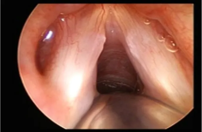 Figura 4. Imagem obtida, através de laringoscopia rígida, de nódulos das cordas vocais 13 