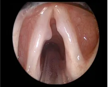 Figura 7. Imagem de um pólipo da corda vocal esquerda, e da lesão traumática na corda vocal  direita 13 