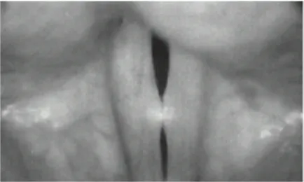 Figura 9. Vista estroboscópica do padrão em ampulheta dos nódulos vocais com encerramento  incompleto da glote 23 .