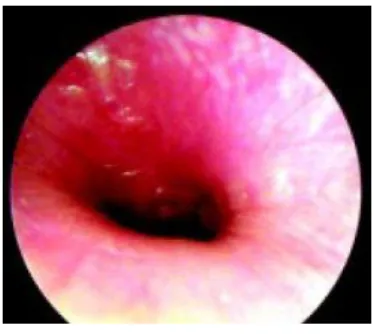 Fig. 8 - Otite externa (Figueiredo et al., 2004) 