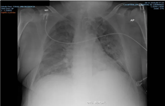 Fig. 2 – Radiografia de tórax PA. 04/11/2016 31