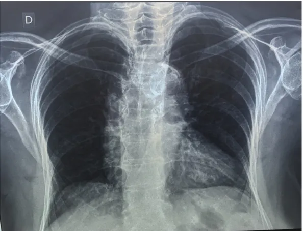 Fig. 4 – Radiografia de tórax PA em pé. Alta ECCI 