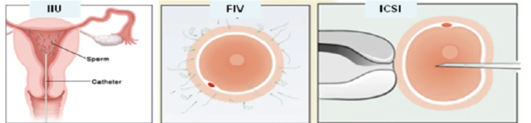 Figura 1 Técnicas de Reprodução Medicamente Assistida: IIU - Inseminação Intrauterina, FIV -  Fertilização in vitro, ICSI - Microinjecção Intracitoplasmática de Espermatozóides.