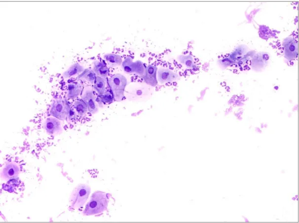 Figure  5  Vaginal  cytology  from  a  XX;SRY-negative  dog  with  a  female  like  phenotype,  showing  the  presence  of  a  large  round  epithelial  cells  and  a  considerable  number  of  neutrophils (Diff-Quick® staining; 200x)