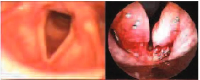 Figura 5. Edema das PPVV á direita, em comparação com PPVV normais á esquerda .   (Retirado de: http://maroma.wordpress.com/2008/11/12/cuidado-com-a-sua-voz/) 