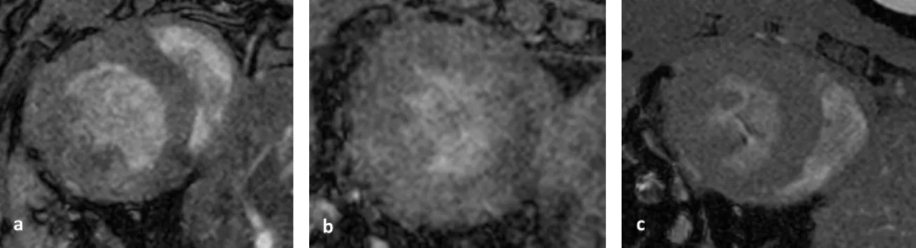 Figure 4 –  Pre-MPIO mid-ventricular slice images of sham (a), IR30 /24h  (b) and IR45 /24h  (c) mice