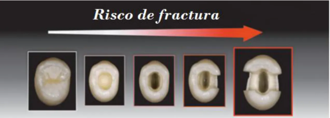 Figura 1. O risco de fractura de um dente endodonciado está relacionado com a quantidade de tecido  perdido e a configuração da cavidade (Adaptado de Rocca &amp; Krejci, 2013)