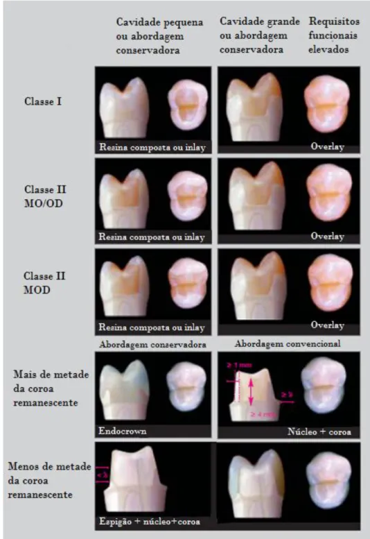 Tabela 5. Recomendações actuais para a restauração de dentes endodonciados (Adaptado de Dietschi et  al