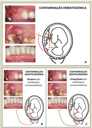 Figura 1. Principais vias de contaminação capazes de justificar uma associação entre a doença  periodontal  e  as  complicações  gestacionais  ‒  A)  Via  hematogénica;  B)  Via  ascendente  com  consequente  ruptura  das  membranas;  C)  Via  ascendente  