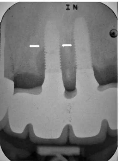 Figure 2. Baseline periapical radiograph at disease diagnosis of implant #11 with bone level located  on the implant’s 5th thread