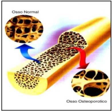 Figura 2- Diferença entre osso normal e osso osteoporótico  Adaptado de www.lookfordiagnosis.com 