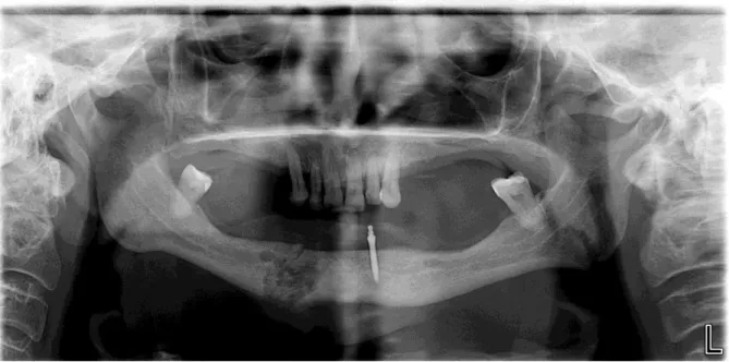 Figura 4- Ortopantomografia realizada na 1ª consulta a  24-01-2012 