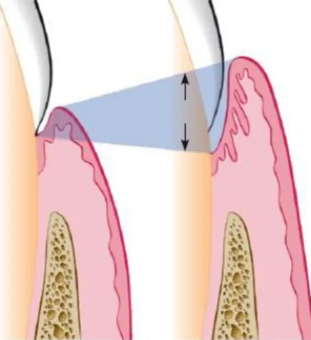 Figura    3:  lustração  da  formação  de  bolsa  indicando  expansão  em  duas  direções  (setas)  a  partir  do  sulco  gengival  normal  (à  esquerda)  para  a  bolsa  periodontal  (à  direita),  adaptado  de  Newman  MG,  Carranza FA