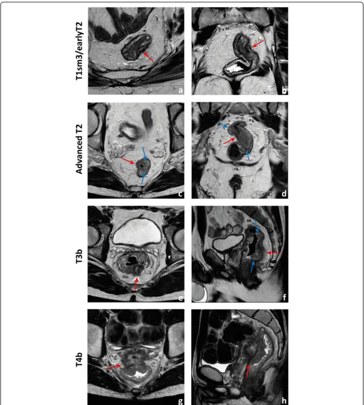 Fig. 12 Examples of differently T-staged tumours. a, b Arrows point to an early polypoid tumour occupying the full depth of the submucosa centrally and therefore staged clinically as mrT1sm3/early T2
