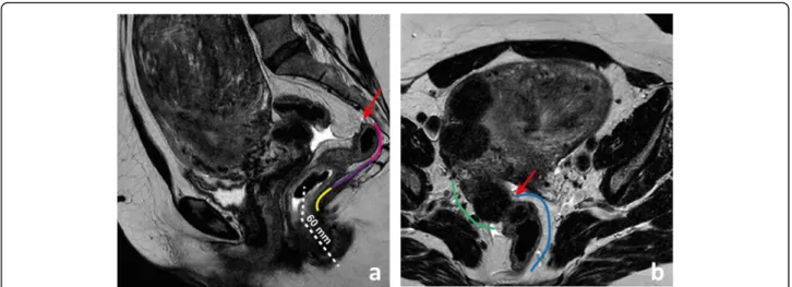 Fig. 2 The upper limit of the rectum corresponds on MR imaging to the point of inflexion between the more vertical rectum and the more horizontal sigmoid “ take off ” (arrow in a)