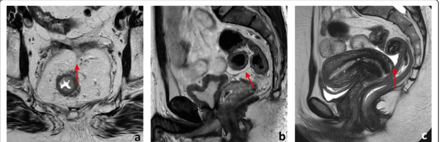 Fig. 6 The peritoneal reflection, when visible, may present with a seagull or V-shaped appearance on the (oblique) axial plane (arrow in a)