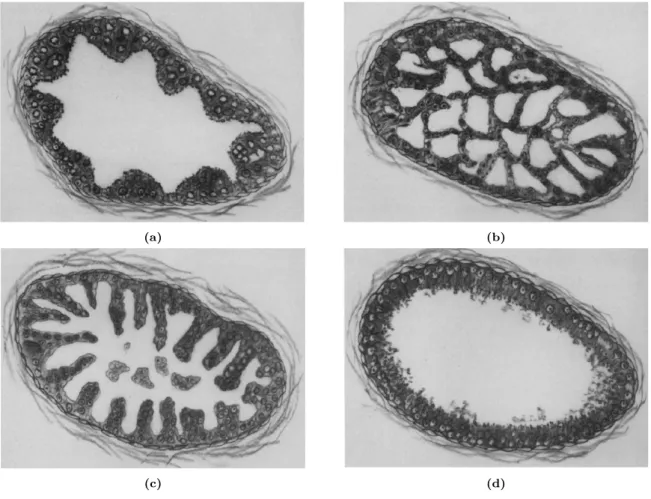 Figure 2.9: Schematic illustration of architectural patterns of high-grade PIN. (a) The tufting pattern shows undulating mounds and heaps of cells protruding into the lumen