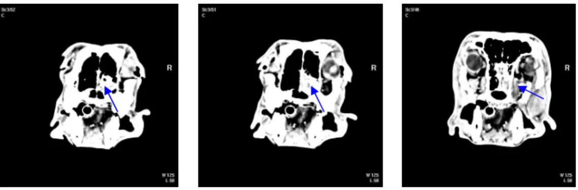Figura  3  –  Imagens  de  TAC  (corte  transversal)  revelando  a  presença  de  opacidade  de  tecido  mole  na  porção direita da cavidade nasal 
