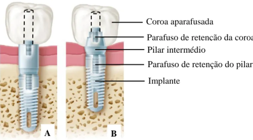 Fig. 2: Sistemas de retenção por aparafusamento. A, Sistema de retenção com pilar intermédio padrão  aparafusado ao implante