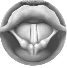 FIGURE 1. - Adduction of the Vocal Folds in PVD. 