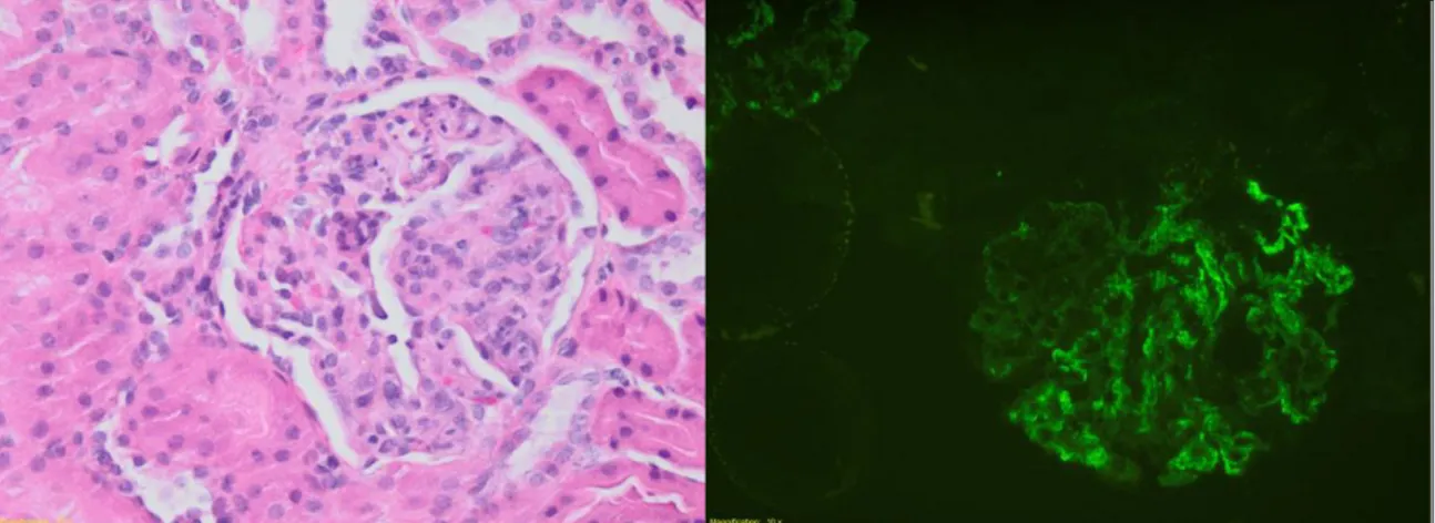 Figura 5 – Histologia que revela glomerulonefrite proliferativa mesangiocapilar focal  Figura 6 – Imunofluorescência com depósitos IgA 
